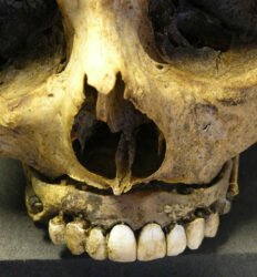 "Dentes de Waterloo": dentaduras com dentes dos soldados mortos em Waterloo
