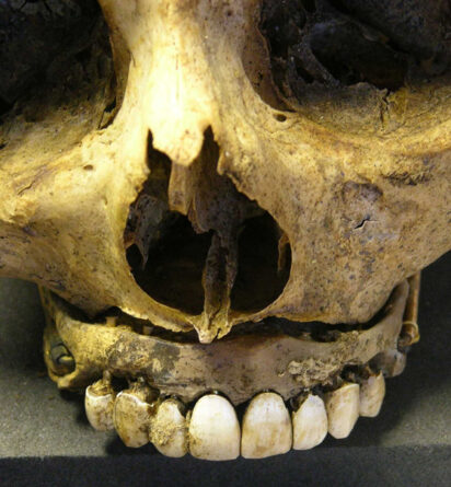 "Dentes de Waterloo": dentaduras com dentes dos soldados mortos em Waterloo